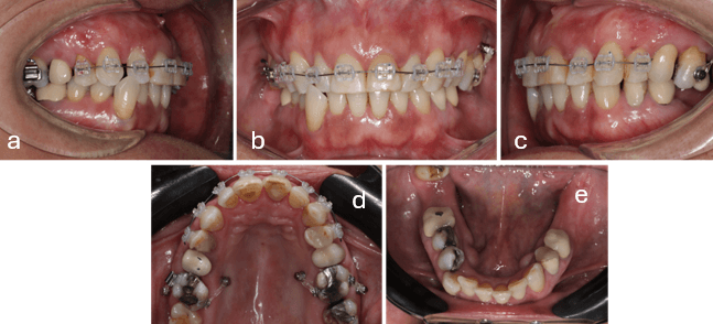 Figura 4.- Cementación superior y biomecánicas de intrusión a) Lateral derecha b) Frontal c) Lateral izquierda d) Oclusal superior e) Oclusal inferior
