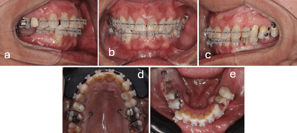 Figura 5.- Cementación inferior, biomecánicas de intrusión de molares superiores y distalización del cuarto cuadrante inferior.