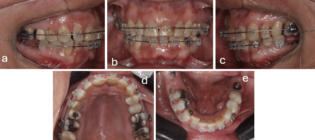 Figura 6.- Anclaje de biomecánica de Intrusión. Mecánica de distalización del cuarto cuadrante y colocación de pilar de conexión de implante dental pieza 3.6. a) Lateral derecha b) Frontal c) Lateral izquierda d) Oclusal superior e) Oclusal inferior