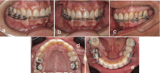 Figura 7. - fotografías Intraorales. Retiro ortodoncia superior. Colocación de coronas sobre implantes piezas 3.6 y 4.6. Coronas piezas 3.4 y 3.5. a) Lateral derecha b) Frontal c) Lateral izquierda d) Oclusal superior e) Oclusal inferior