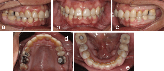 Figura 8. - Fotografias Intraorales finales. a) Lateral derecha b) Frontal c) Lateral izquierda d) Oclusal superior e) Oclusal inferior