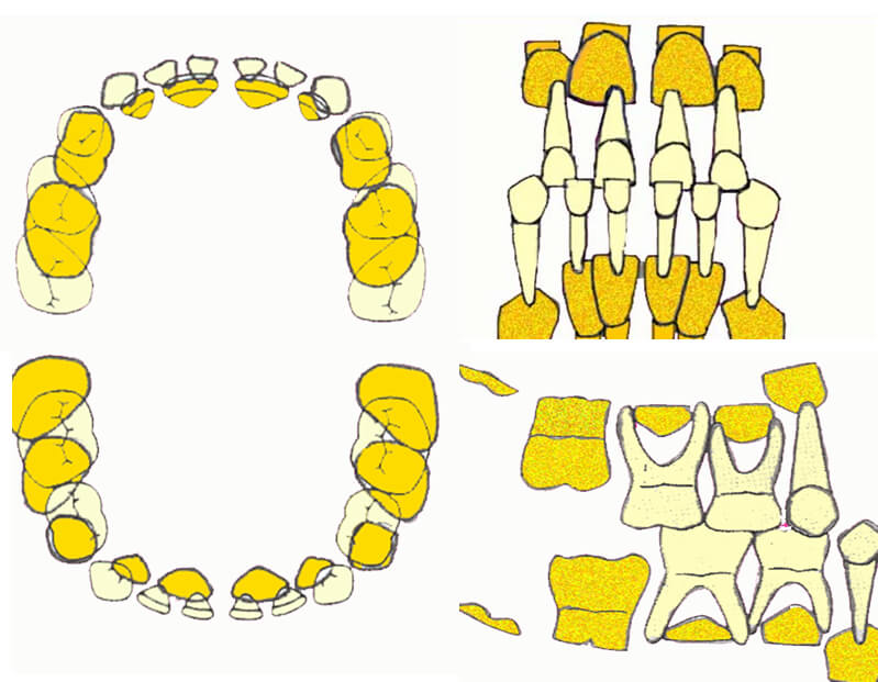 Fig.2. Desarrollo de la dentición en la maloclusión Clase III en la dentición primaria. Fuente: van der Linden (1983)