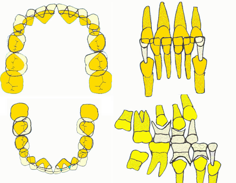 Fig.3. Desarrollo de la dentición en maloclusión Clase III, en el período de dentición mixta. Fuente: van der Linden (1983)
