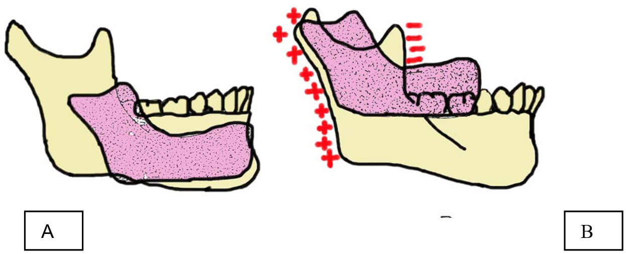 Fig. 6. Cambios en la morfología de la mandíbula. A) Aposición a nivel del borde posterior de la rama y resorción anterior. Nótese crecimiento vertical asociado por la erupción de los dientes. B) Se observan las dos ubicaciones de la mandíbula en relación con el crecimiento de traslación o desplazamiento espacial. Fuente. Ordoñes (1984)
