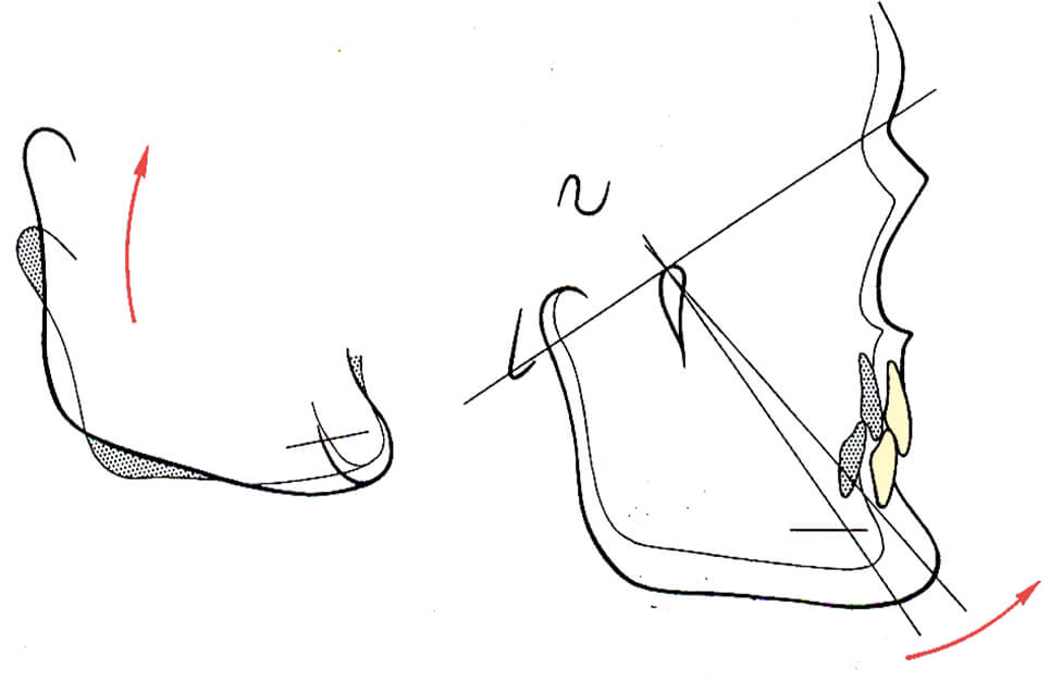 Fig. 7.Crecimiento del cóndilo hacia adelante y arriba con rotación anterior de la sínfisis. Fuente. Canut (2000)