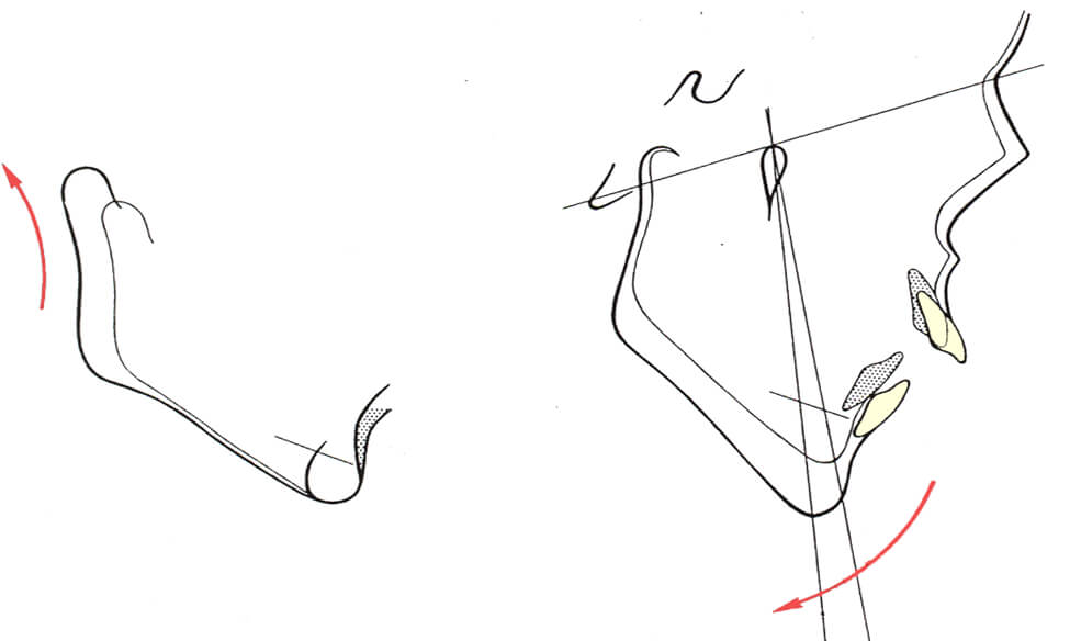 Fig. 8.Crecimiento del cóndilo hacia atrás y arriba con rotación posterior de la sínfisis. Fuente. Canut(2000)