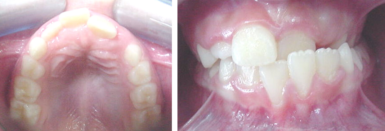 Fig.10. A) Vista oclusal superior, obsérvese la constricción transversal B) mordida cruzada anterior y posterior.