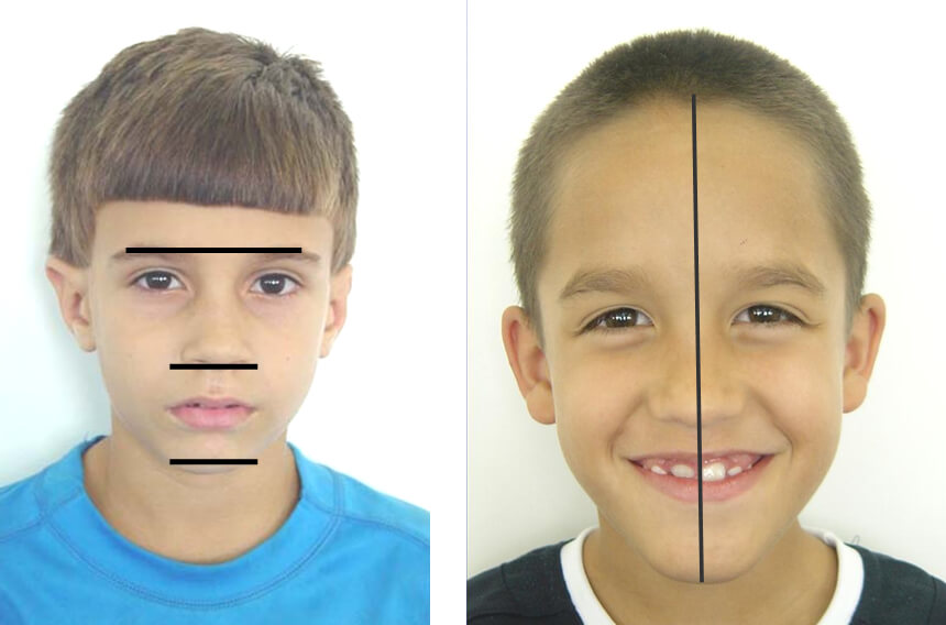 Fig.12. Análisis frontal. A) Representación esquemática. B) Fotografía de un niño de 8 años.