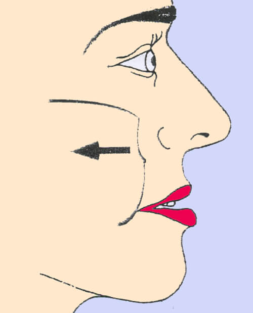 Fig. 14. Evaluación del perfil, nótese el perfil cóncavo, y el aplanamiento en el borde infraorbitario y la zona adyacente a la nariz. Tomado de: Arnett