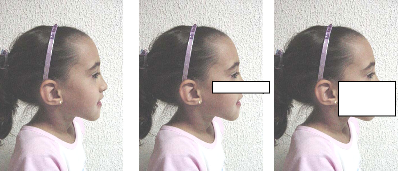 Fig. 15. Evaluación del perfil en paciente con maloclusión clase III. A), perfil facial en una niña de 8 años, que muestra perfil recto. B) Bloqueando los labios, se evalúa la posición del mentón en relación con la nariz y el tercio superior. C, se bloquea el labio inferior, el mentón y se evalúa el macizo facial.