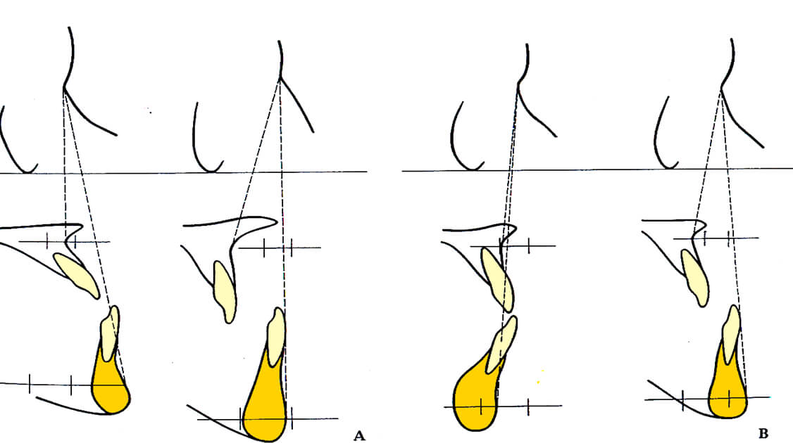 Fig. 16. Clasificación de las maloclusiones Clase III según Sanborn