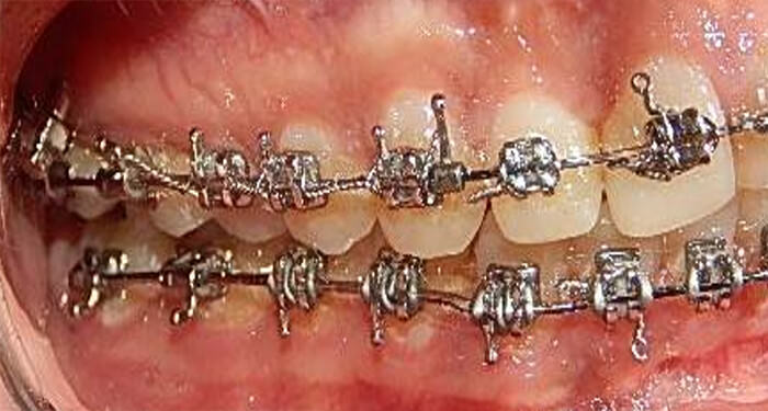 Fig. 15 Lateral derecha