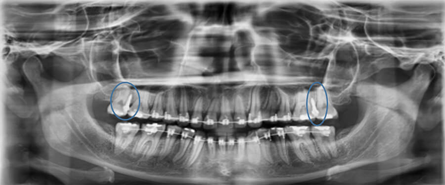 Fig. 18 Rx Panorámica de progreso