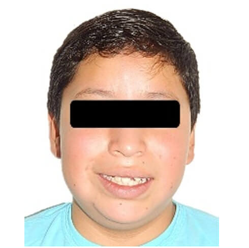 Fig. 1. extraoral de frente