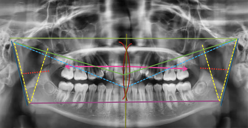Fig. 8 Trazos análisis de Levandoski los cuales nos muestran con líneas de colores, la discrepancia en medidas entre un lado con relación al otro.