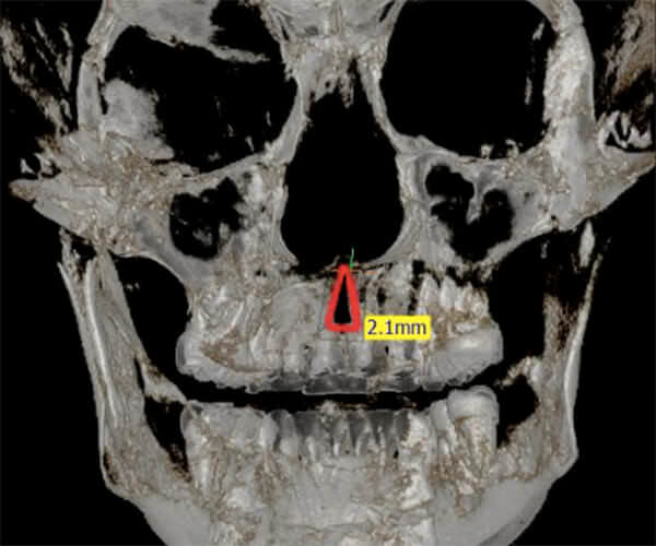 Fig. 18 Tomografía 3D de frente