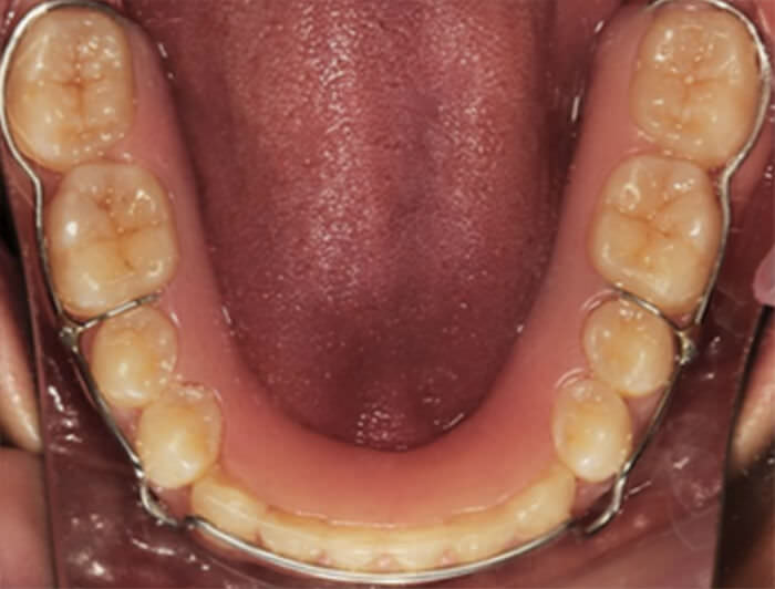 Fig.24 vista inferior oclusal
