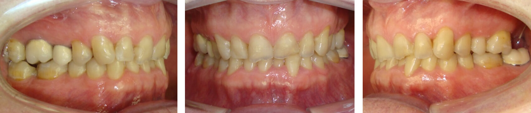 A. Lateral derecha / B. Frontal / C. Lateral izquierda Figura 1. Fotografías intraorales