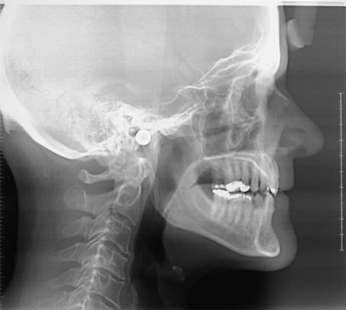 Figura 4. Telerradiografía de perfil, apófisis estiloides elongada.