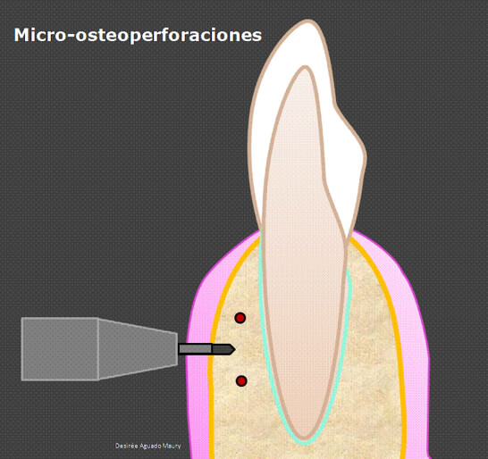 Figura 2. Micro-osteoperforaciones