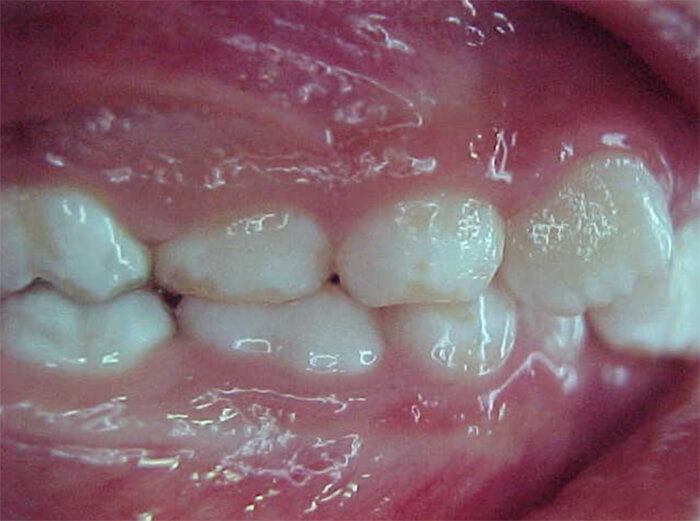 Fig. 4 Oclusal derecha inicial.