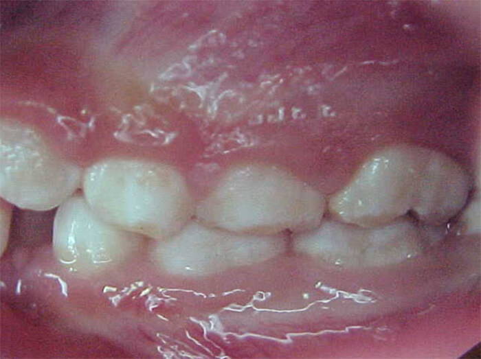 Fig. 5 Oclusal izquierda inicial.