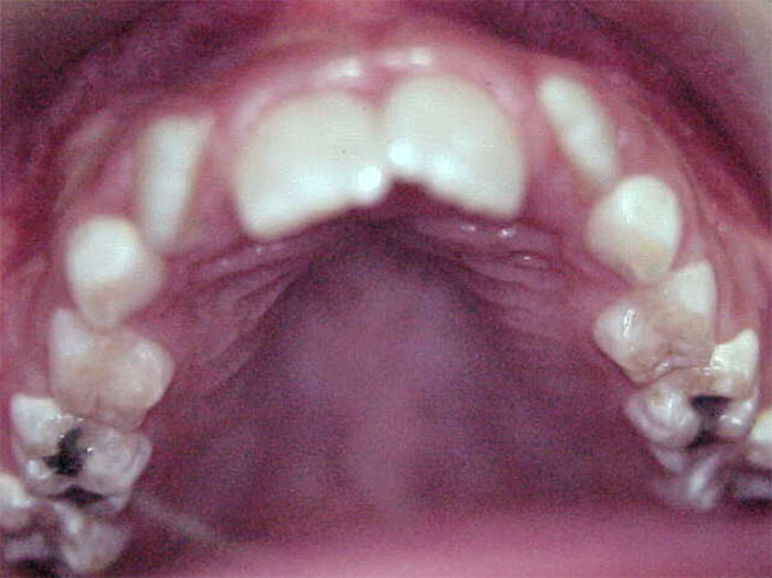 Fig. 6 Oclusal superior inicial.