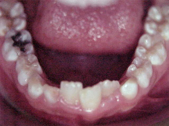 Fig. 7 Oclusal inferior inicial.