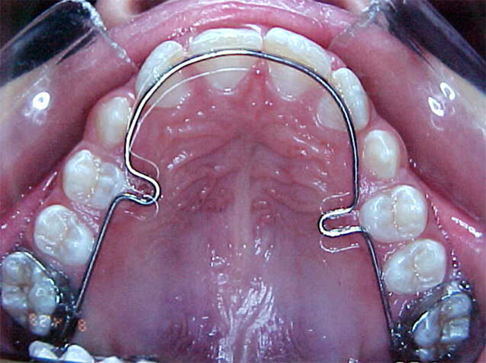 Fig. 12 Expansión dentoalveolar superior