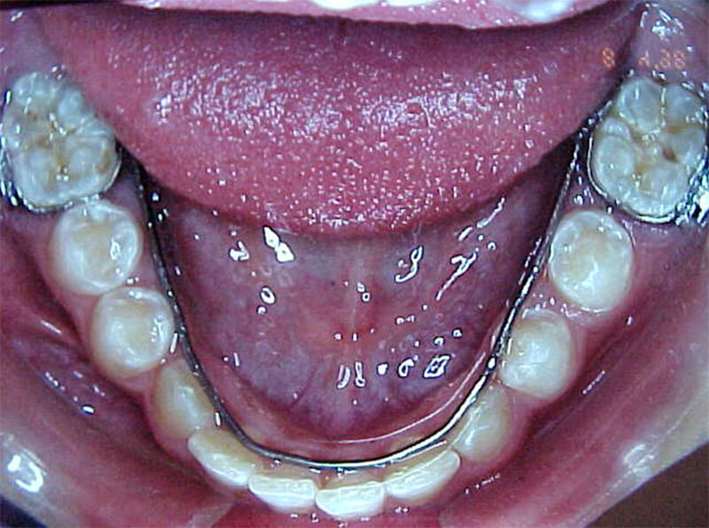 Fig. 13 Anclaje inferior