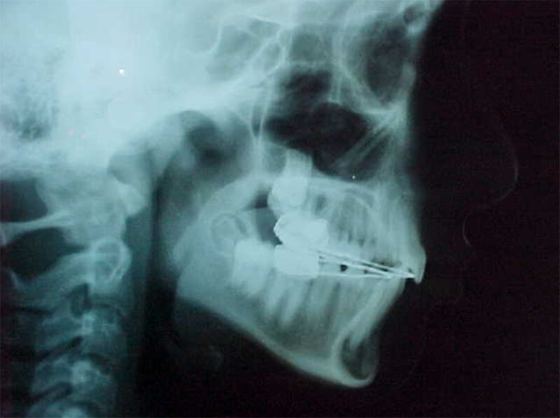Fig. 15 Radiografía lateral de cráneo intermedia