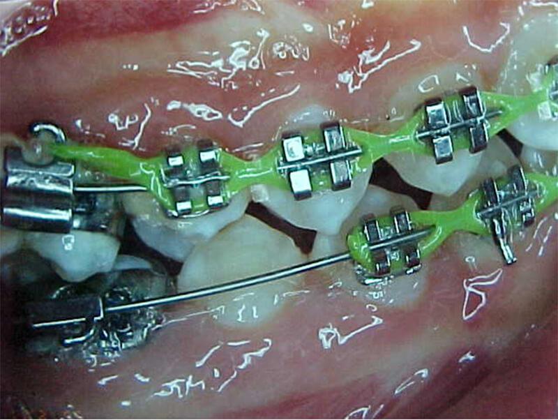 Fig. 17 Lateral derecha intermedia
