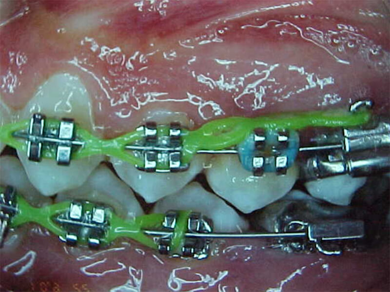 Fig. 18 Lateral izquierda intermedia