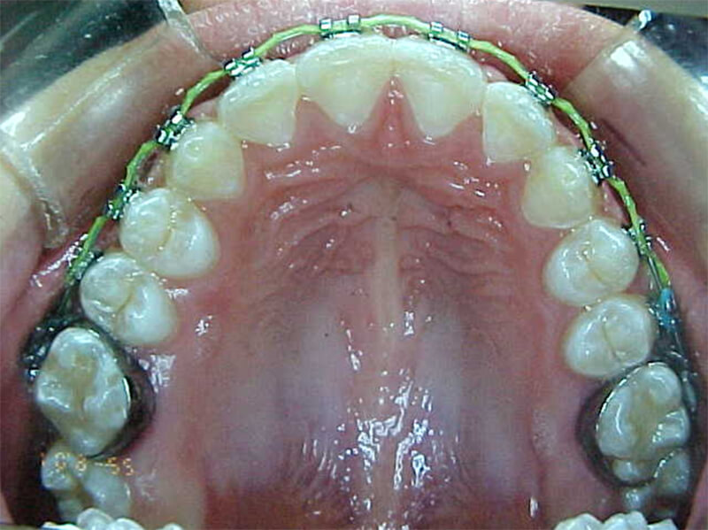 Fig. 19 Oclusal superior intermedia