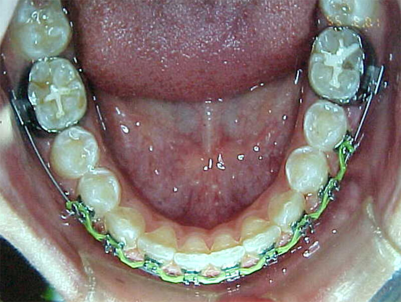 Fig. 20 Oclusal inferior intermedia