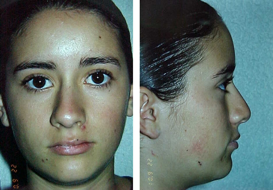 Fig. 23 y 24 - Extraoral final / Perfil final