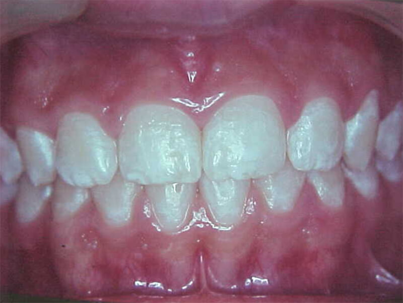 Fig. 25 Frontal final