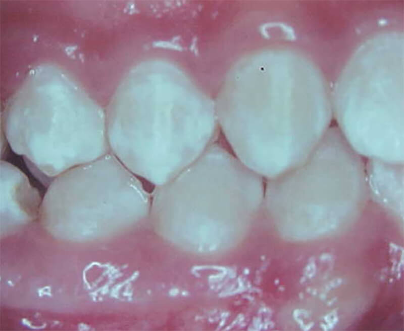 Fig. 26 Oclusal derecha final