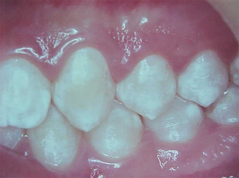 Fig. 27 Oclusal izquierda final