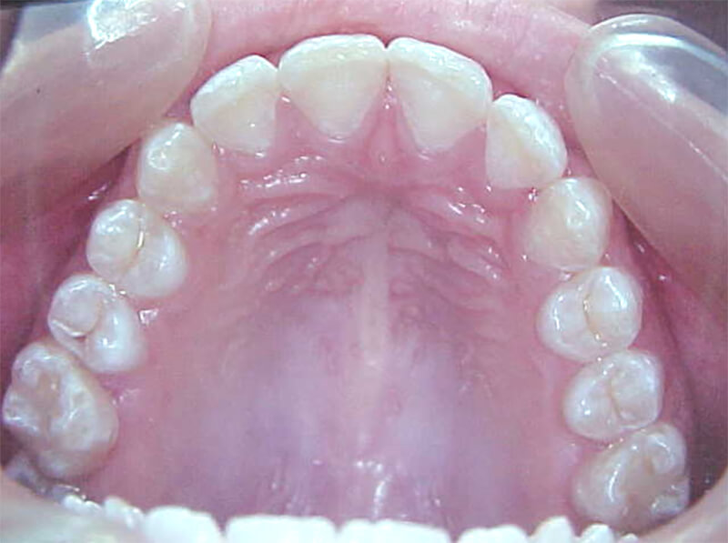 Fig. 28 Oclusal superior final