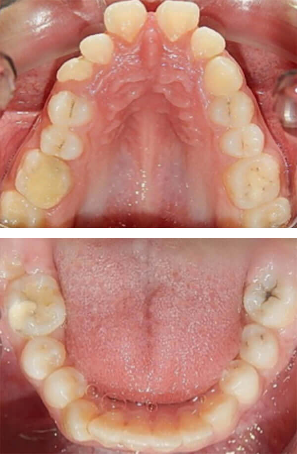 Fig.5 Oclusal superior e inferior