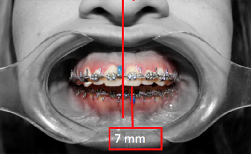 Fig.8 Descompensación dental