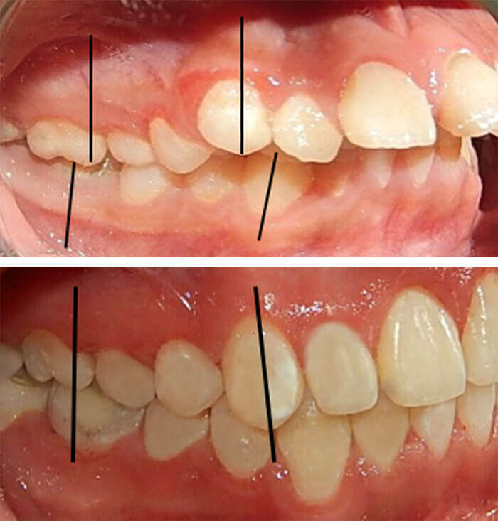 Fig. 13 Lateral derecha de inicio y final
