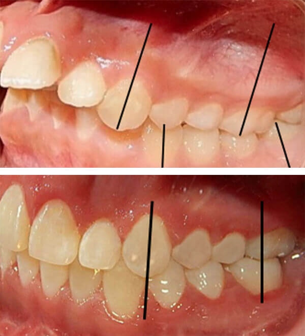 Fig. 14 comparación izquierda inicio y final