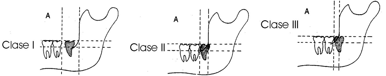 Gráfico 1 Clasificación de impactación del tercer molar inferior. Tomado de Koerner, 1994.