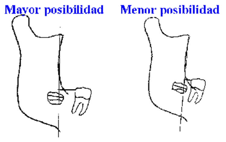 Gráfico 2 Diagrama donde se representa la mayor o menor posibilidad de erupción del tercer molar. Tomado de Quirós-Palma 1999.
