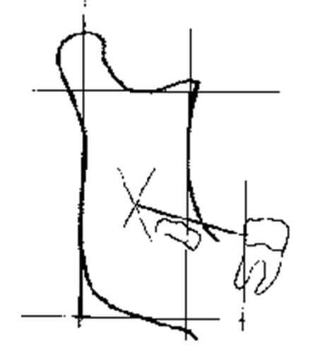 Gráfico 4 Distancia de la zona distal del segundo molar al punto Xi. Tomado de Quirós-Palma 1994