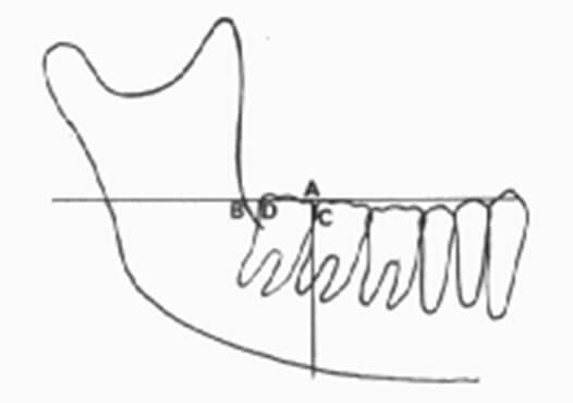 Gráfico 5 Diagrama que representa la medición de espacio disponible en radiografía cefálicas laterales. A, punto en el plano oclusal perpendicular al punto mas distal de la corona del segundo molar inferior. B intersección del plano oclusal y borde anterior de la rama. Tomado de Olive-Basford. 1981.