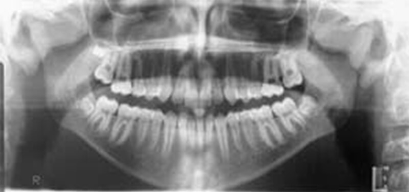 Gráfico 6 A través de la Radiografía Panorámica se facilita el estudio de la disponibilidad del espacio para el tercer molar inferior