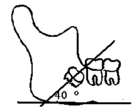 Gráfico 7 Angulación entre el tercer molar y plano mandibular. Tomado de Quirós-Palma